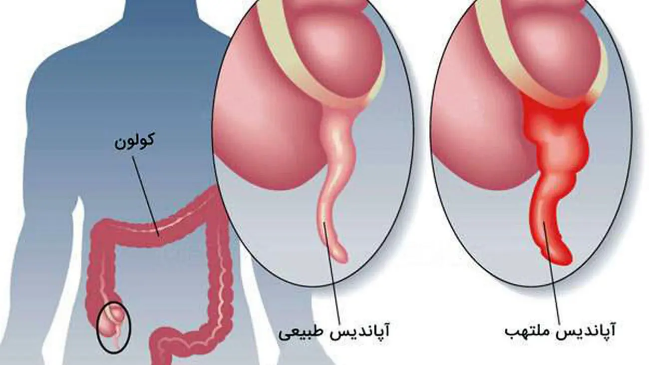 این هشدارهای بدن رو جدی بگیرید | نشانه های کوچک و بزرگ ترکیدن آپاندیس