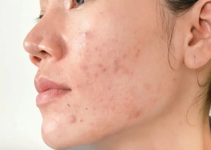 این جوش هارو جدی بگیرید اونا علاوه بر مزاحم بودن زنگ خطر بیماری اند