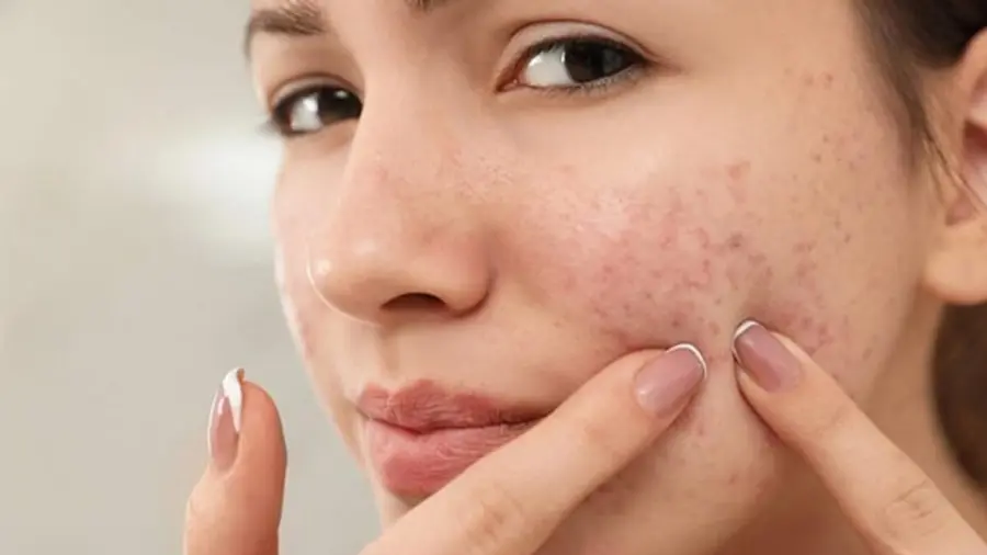 مهمونی دعوتی و جوش مجلسی زدی؟ بیا اینجا یه روش بگم سه سوته از شر جوشت خلاص شی