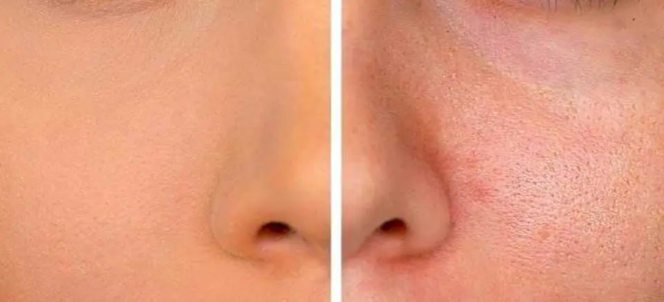 چگونه منافذ پوست را ببندیم؟ | راهکارهای خانگی و تخصصی برای بستن منافذ پوست