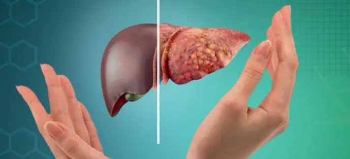 به این علامت هشدار توجه کنید | پاهای شما خبر از  نشانه بیماری کبد چرب می دهد