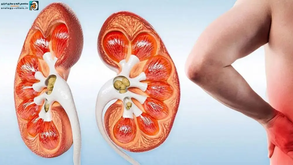  سنگ کلیه را با خوردن چه چیزهایی نابود کنیم؟ 