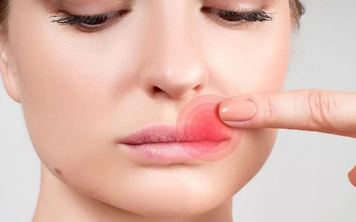 درمان یک روزه تبخال لب با این ترفندها