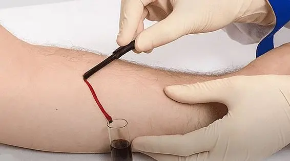 فصد خون چیست؟ فواید شگفت‌انگیز، عوارض احتمالی و بهترین زمان انجام آن