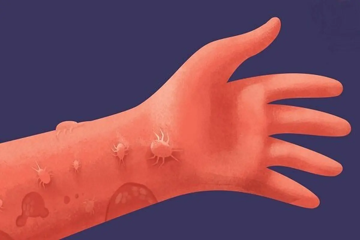 اگه همیشه حس میکنی حشره رو بدنت راه میره بدون این بیماری و داری!