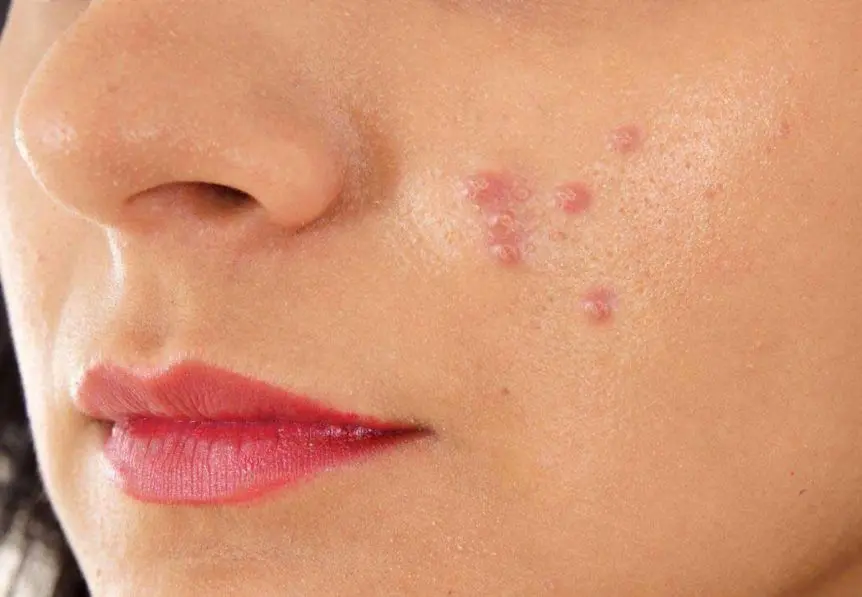 واسه جوشای صورتت زیاد هزینه نکن | یک روش کاملا خانگی و بصرفه برای خلاص شدن از جوش صورت برای همیشه