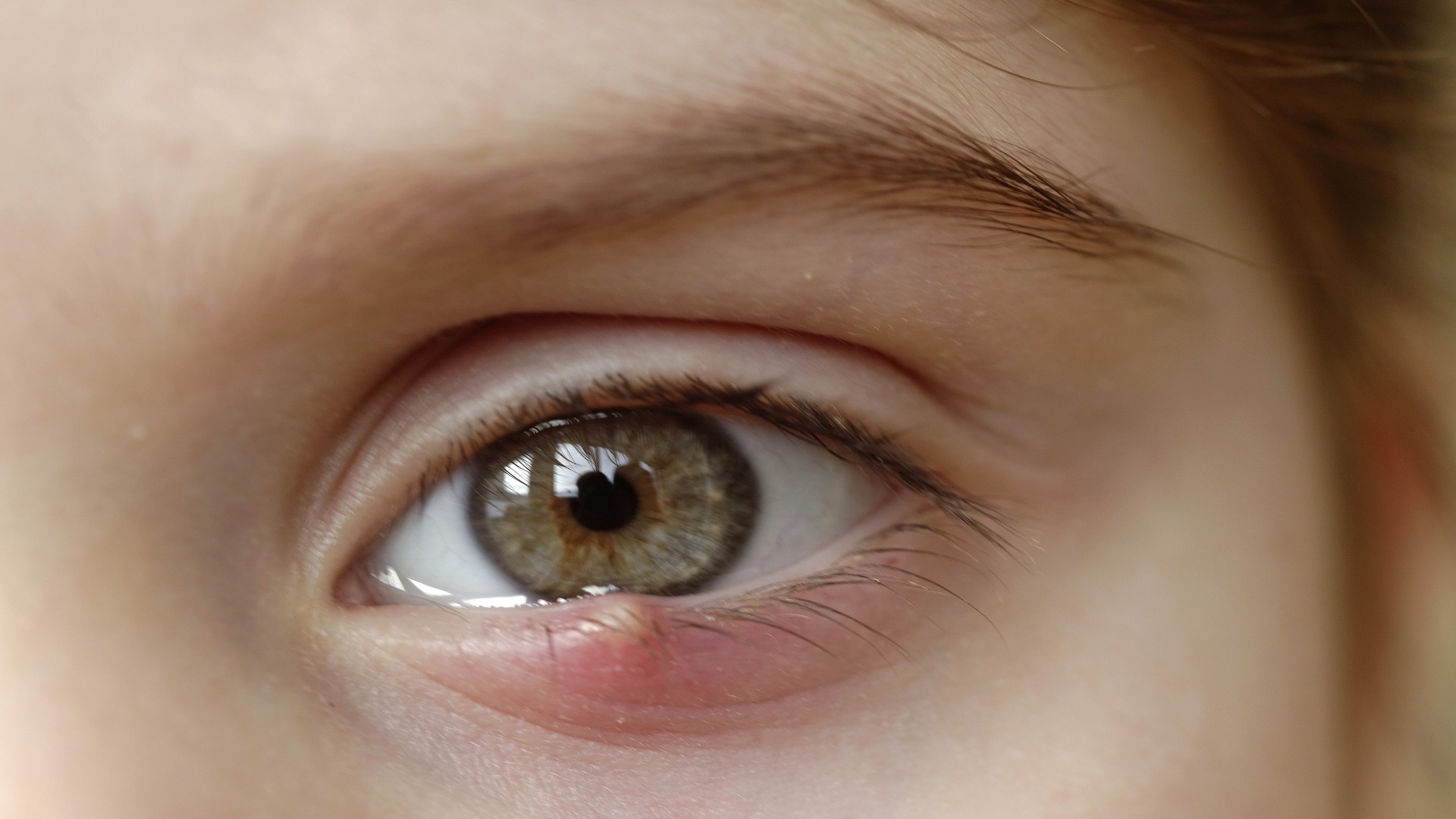 سریع ترین روش های درمان خانگی گل مژه