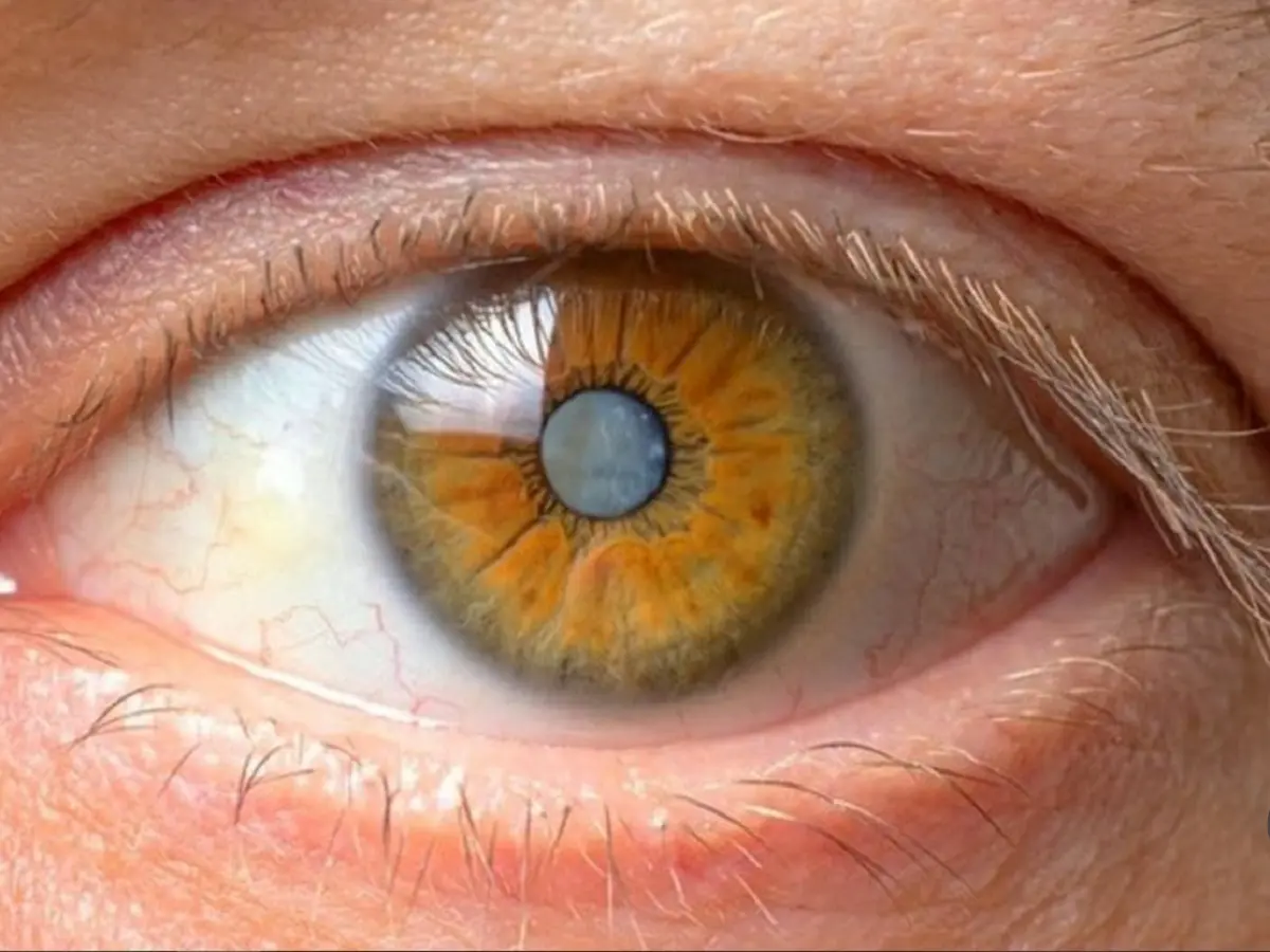 پیشگیری از آب مروارید با این راهکارهای ساده