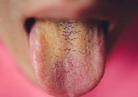 هشدار مرگبار | زردی زبان را جدی بگیرید