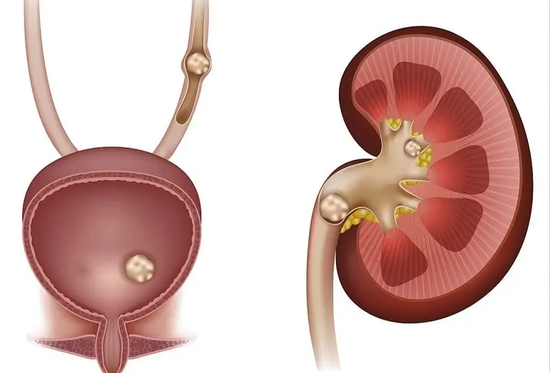  چگونه به خروج سنگ‌ کلیه سرعت بدهیم؟ 