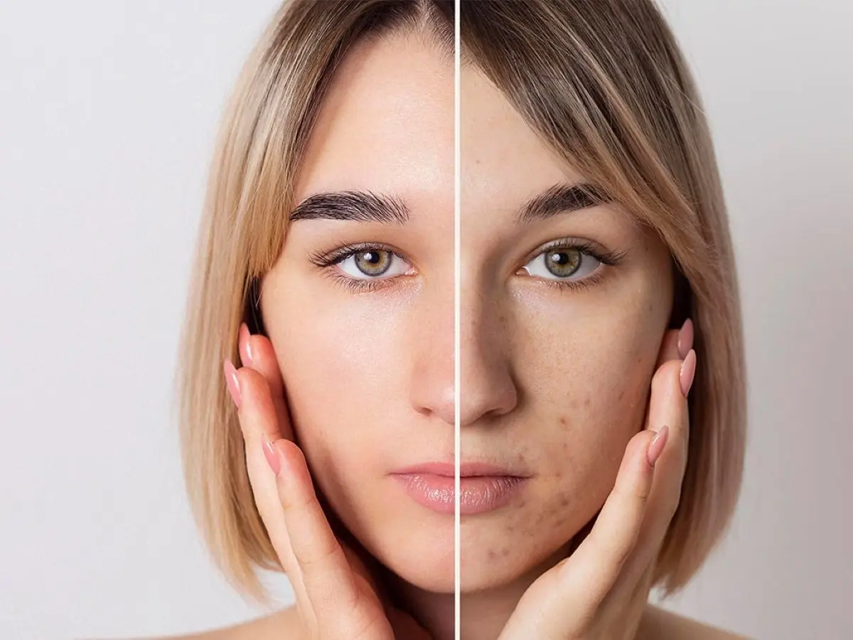 ترفند از بین بردن جای جوش در یک روز در خانه ؛ ترکیب گیاهی دست ساز فوری