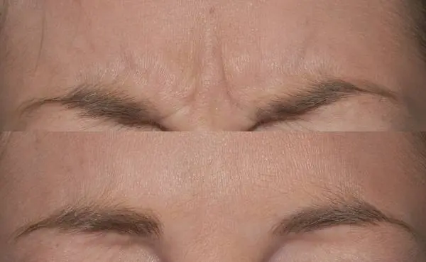 رفع خط اخم بدون هزینه و بوتاکس | خط اخمتو با مواد خانگی از بین ببر و صافش  کن