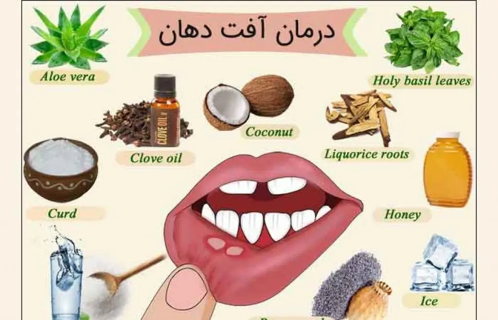 درمان خانگی آفت دهن در سه سوت با مواد دم دستی