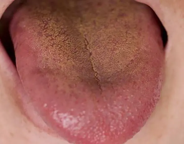 علائم کبد چرب در زبان