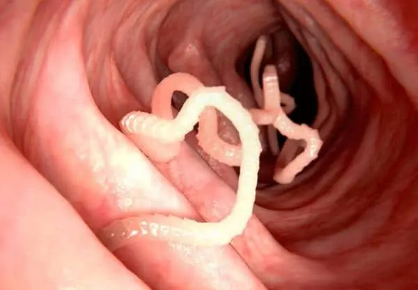 اگر این نشانه ها و علائم را دارید بدن شما پر از کرم و انگل شده است