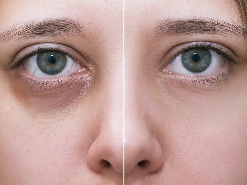 مهمترین علت‌های مهم گودی زیر چشم + بهترین روش های درمان خانگی رفع گودی چشم