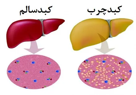  گیاهی برای غلبه بر کبد چرب 