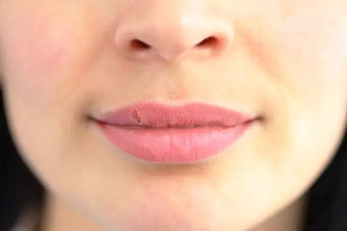 تو سیم ثانیه تبخال صورتت رو از بین ببر + روش کاملا خانگی