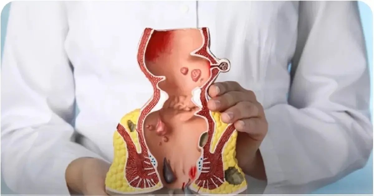 بواسیر و درمان‌های خانگی که به مردم کمک کرد؛ چه زمانی باید به پزشک مراجعه کرد؟