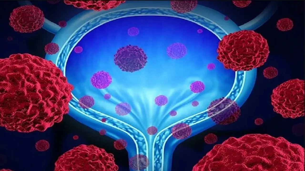  با این روش ها یک مثانه صفر کیلومتر تحویل بگیرید 