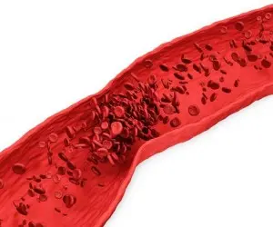  این علائم میگه یه جای بدنت خون لخته شده! 