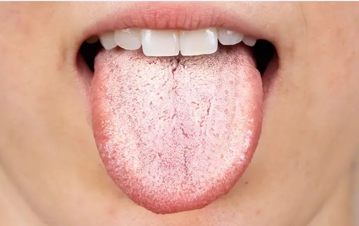 اگر زبان سفیدی دارید این خبر برای شماست