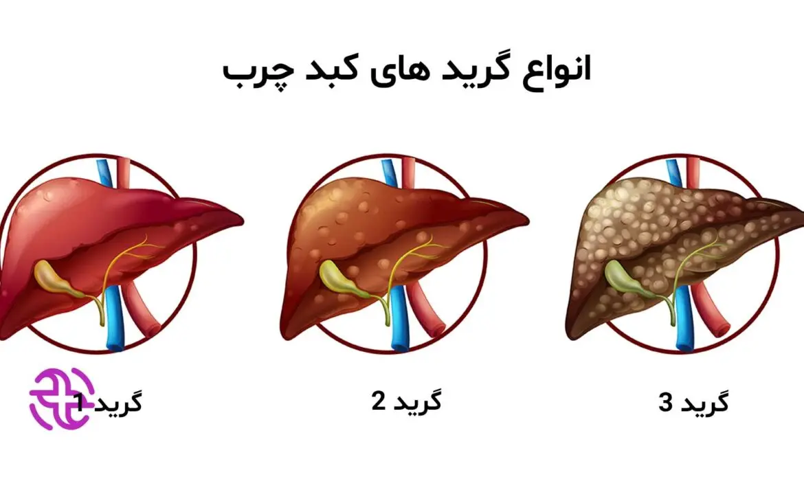 کبد چرب