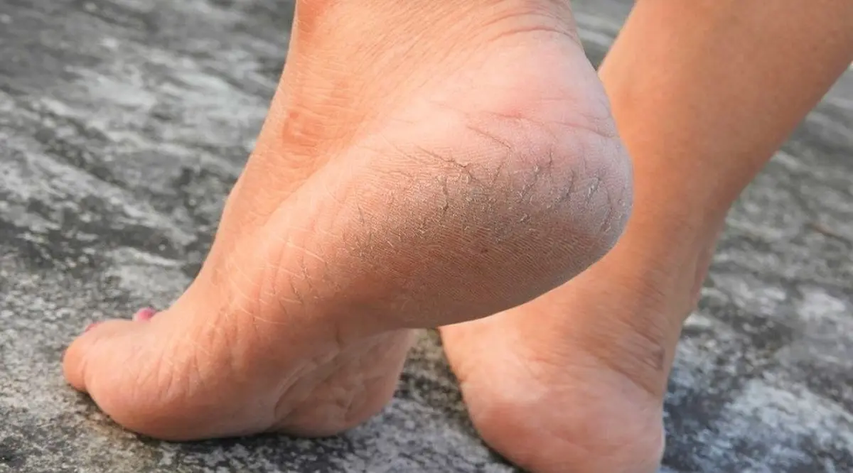 چگونه ترک کف پا را سریع و موثر درمان کنیم؟؛ درمان خانگی ترک کف پا تنها در 2 روز