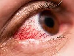 این علائم می گوید چشم شما در حال نابودی است