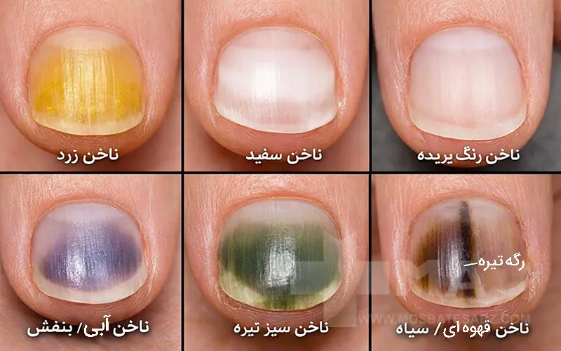 انواع بیماری‌های ناخن و راه درمان آن‌