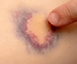 هر رنگ کبودی روی بدن نشان چه بیماری است؟ | رنگ کبودی‌ها بدن خبر از چه بیماری می دهد؟ 