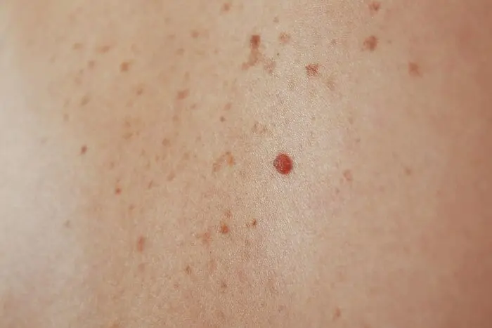 اگر خال بدنتان این رنگی است در معرض سرطان هستید