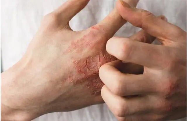  با این راهکارها از خشکی پوست جلوگیری کنید 