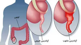 این هشدارهای بدن رو جدی بگیرید | نشانه های کوچک و بزرگ ترکیدن آپاندیس