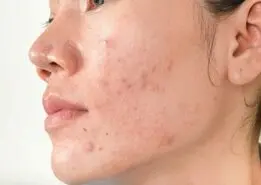 این جوش هارو جدی بگیرید اونا علاوه بر مزاحم بودن زنگ خطر بیماری اند