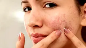 مهمونی دعوتی و جوش مجلسی زدی؟ بیا اینجا یه روش بگم سه سوته از شر جوشت خلاص شی