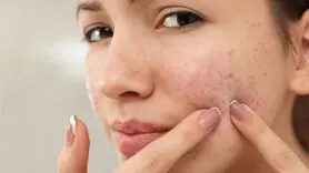 مهمونی دعوتی و جوش مجلسی زدی؟ بیا اینجا یه روش بگم سه سوته از شر جوشت خلاص شی