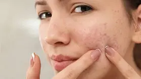 مهمونی دعوتی و جوش مجلسی زدی؟ بیا اینجا یه روش بگم سه سوته از شر جوشت خلاص شی