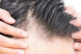 این نوشیدنی محبوب ریزش مو مردان را افزایش می دهد