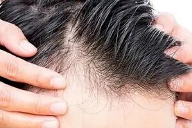 این نوشیدنی محبوب ریزش مو مردان را افزایش می دهد