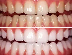 در خانه و با ارزان ترین مواد دندان خود را مثل برف سفید کنید | بدون نیاز به هزینه های زیاد دندانپزشکی دندان هاتو سفید کن