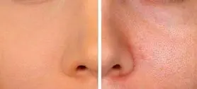 چگونه منافذ پوست را ببندیم؟ | راهکارهای خانگی و تخصصی برای بستن منافذ پوست