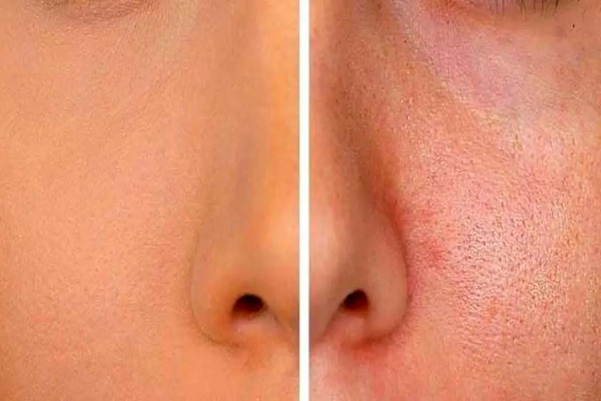 چگونه منافذ پوست را ببندیم؟ | راهکارهای خانگی و تخصصی برای بستن منافذ پوست