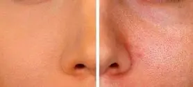 چگونه منافذ پوست را ببندیم؟ | راهکارهای خانگی و تخصصی برای بستن منافذ پوست