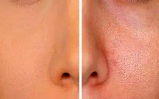 چگونه منافذ پوست را ببندیم؟ | راهکارهای خانگی و تخصصی برای بستن منافذ پوست