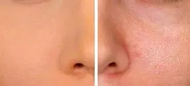 چگونه منافذ پوست را ببندیم؟ | راهکارهای خانگی و تخصصی برای بستن منافذ پوست