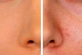 چگونه منافذ پوست را ببندیم؟ | راهکارهای خانگی و تخصصی برای بستن منافذ پوست