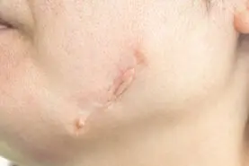 با این ترفند طلایی جای زخم و از بین ببر | درمان خانگی از بین بردن جای زخم

