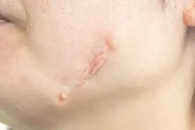 با این ترفند طلایی جای زخم و از بین ببر | درمان خانگی از بین بردن جای زخم
