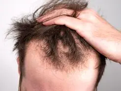با این معجون از شر ریزش مو خلاص شو | با چند ماده طبیعی معجون ضد ریزش مو بسازید!
